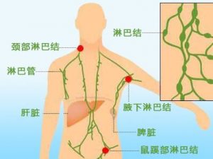 淋巴瘤的早期症状和治疗？