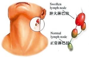 依鲁替尼—慢性淋巴细胞白血病患者的福音 