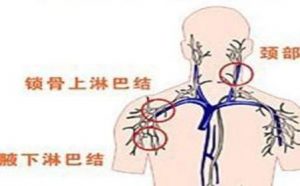 依鲁替尼治疗巨球蛋白血症的疗效